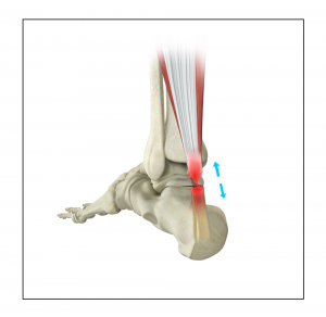 Achilles Tendon Repair