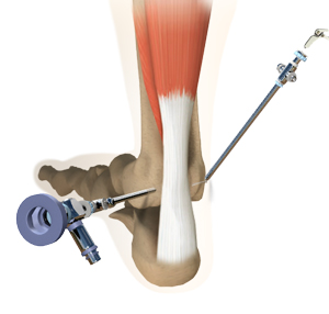 Arthroscopic Surgery