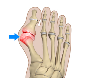 Bunion Surgery