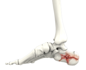 Foot Fractures