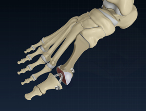 Bunion/Hallux Valgus