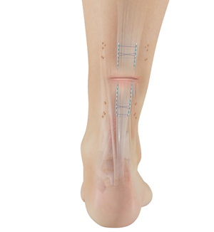 Ankle Arthrodesis