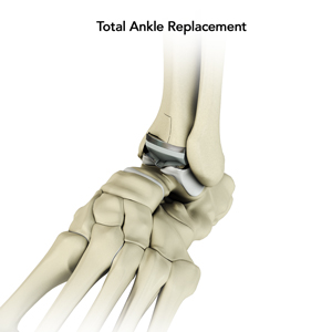 Total Ankle Replacement