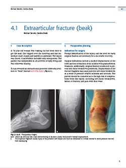 Book Chapter on Extra-articular Calcaneal Fracture Treatment