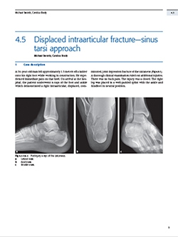 Book Chapter on Minimally Invasive Calcaneus Fracture Treatment